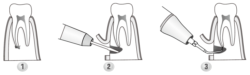 Сфера применения наконечника для скалера